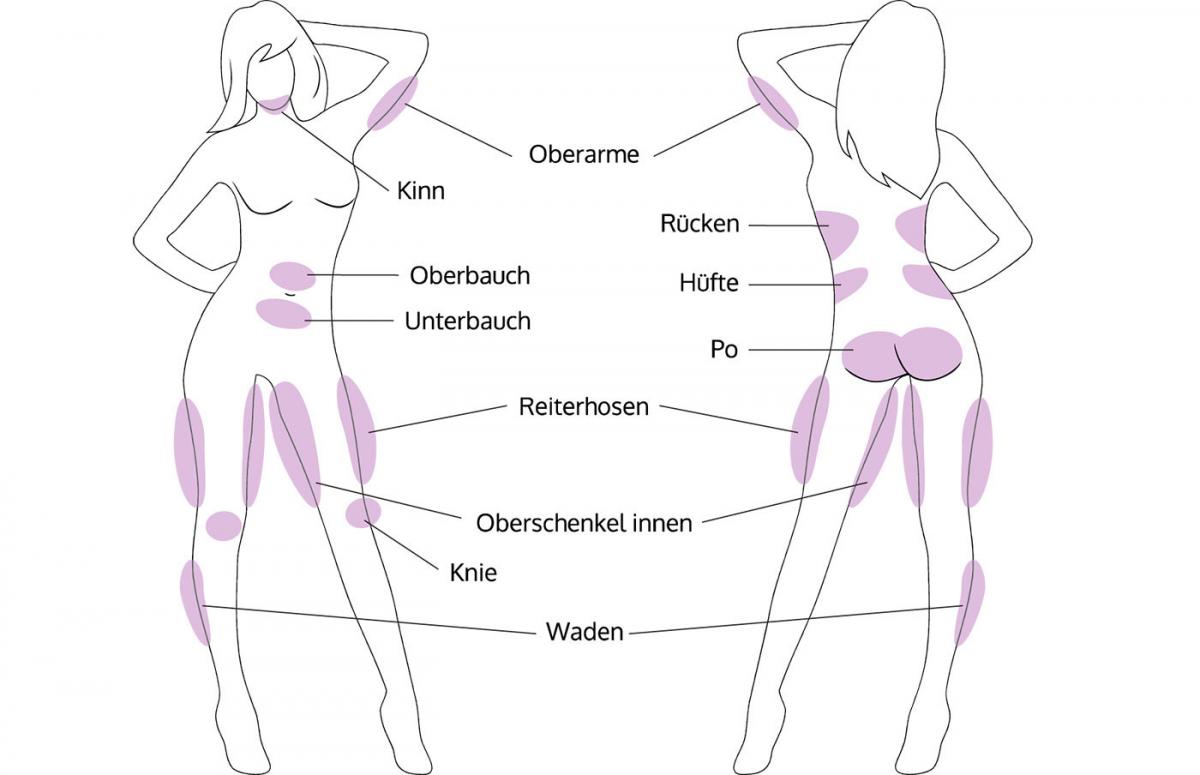 Illustration von möglichen Zonen bei einer Fettabsaugung