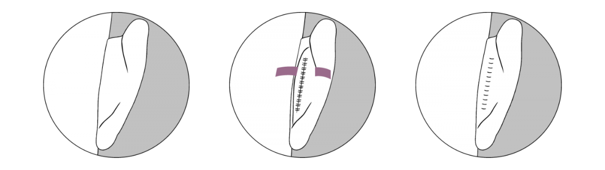 Illustration einer klassischen Ohrenkorrektur in drei Schritten