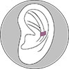 Illustration Ohrenkorrektur mit Earfold